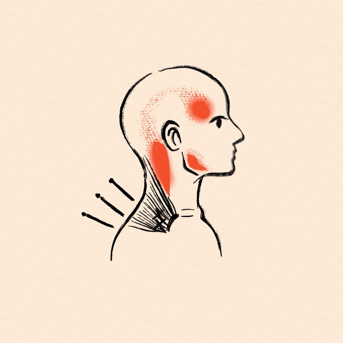 Dry Needling at Chenming TCM Clinic, Bangkok Chinatown near Hua Lamphong MRT